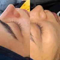 پاکسازی و فیشال پوست