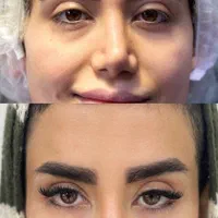 کاشت مو / ابرو / مژه|خدمات آرایشگری و زیبایی|تهران, زعفرانیه|دیوار