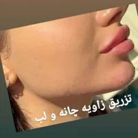 بوتاکس ،فیلر و ژل لب ، لیفت نخ ، انزیم ،مزوتراپی|خدمات آرایشگری و زیبایی|مشهد, جانباز|دیوار