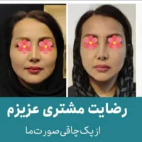 چاقی صورت با جوانه گندم(تضمینی)