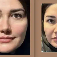 جشواره چربی ژل بوتاکس مزو نخ ساکشن شکم