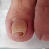 درمان ناخن های فرو رفته در گوشت(ارتونیل)