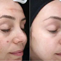 پاکسازی و جوانسازی پوست و رفع عارضه