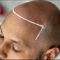 میکرو اسکالپ موی سر ،ریش، ابرو( در محل)|خدمات آرایشگری و زیبایی|تهران, سعادتآباد|دیوار