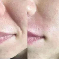 ژل و بوتاکس|خدمات آرایشگری و زیبایی|چناران, |دیوار