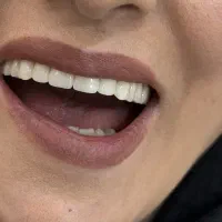 دندانسازی آوا قرارداد مستقیم کلیه بیمه ها|خدمات آرایشگری و زیبایی|خرم‌آباد, |دیوار