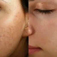 فیشیال و پاکسازی صورت جشنواره یلدایی|خدمات آرایشگری و زیبایی|شیراز, شهرک مهدیه|دیوار