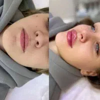 ژل و بوتاکس فیلر چربی مزو|خدمات آرایشگری و زیبایی|مشهد, طلاب|دیوار