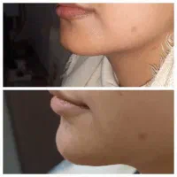 ارایه خدمات زیبایی مزووایت نیدلینگ پلکسر ژل بوتاکس