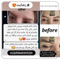 ریموو تتو با مواد آمریکایی تضمین سلامت پوست|خدمات آرایشگری و زیبایی|همدان, |دیوار