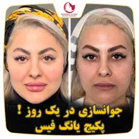 فرمدهی صورت بینی بدون جراحی بیهوشی پکیج یانگ فیس|خدمات آرایشگری و زیبایی|مشهد, هفت تیر (حافظ)|دیوار