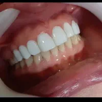 کامپوزیت و روکش با تخفیف ویژه