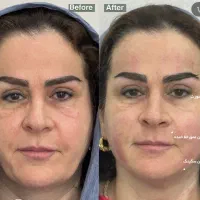 هایفو صورت و واژینال با دقت هوش مصنوعی افر تافردا|خدمات آرایشگری و زیبایی|مشهد, آزادشهر|دیوار