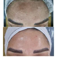 خدمات پاکسازی پوست ، پلکسر، میکرونیدلینگ|خدمات آرایشگری و زیبایی|تهران, پاسداران|دیوار
