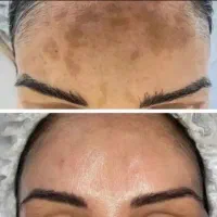 درمان ریشه ای لک بدون لیزر