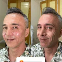 مدل برای درمان افتادگی های صورت و ژل لب و بوتاکس|خدمات آرایشگری و زیبایی|تهران, میرداماد|دیوار