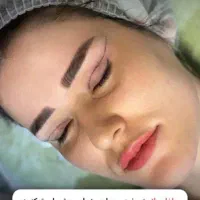 جراحی بلفاروپلاستی