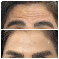 بوتاکس پیشانی و دور چشم