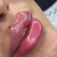 ژل وبوتاکس وفیلربینی