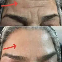 بدون جراحی و تزریق بوتاکس پوستتو جوان کن
