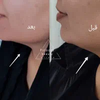 جشنواره هایفو فول فیس ۳۶ بعدی جدید ترین هایفو سال