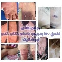 رفع مشکلات پوست و مو|آرایشی، بهداشتی، درمانی|بندر ترکمن, |دیوار