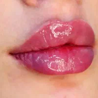 تزریق ژل وبوتاکس