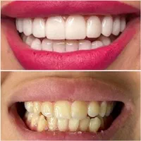 کامپوزیت بدون تراش باقیمت استثنایی