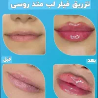 50٪تخفیف خدمات فیلر بوتاکس مزوتراپی پرسینگ چال لپ|خدمات آرایشگری و زیبایی|اصفهان, مولوی|دیوار