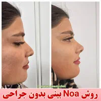 فرمدهی صورت بینی بدون جراحی بیهوشی پکیج یانگ فیس|خدمات آرایشگری و زیبایی|مشهد, هفت تیر (حافظ)|دیوار
