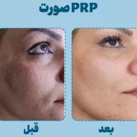 پی ار پی ،پی ار اف و مزوتراپی صورت و مو