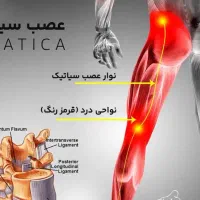 کاهش دردهای شدید کمر و زانو دیسک سیاتیک