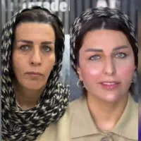 هایفو(جشنواره فقط تاامروز)بدون تزریق/فقط890ت/1جلسه