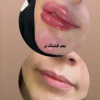 (کلینیک زیبایی) فیلر،بوتاکس مزوژل جوانساز، ضدلک|خدمات آرایشگری و زیبایی|قشم, |دیوار
