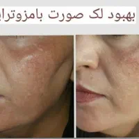 آموزش تخصصی فیشیال،مزوتراپی،خالبرداری|خدمات آرایشگری و زیبایی|خمینی‌شهر, |دیوار