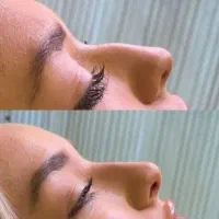 آموزش نخ لیفت فیلر ژل بوتاکس لیزر مو فشیال طب سنتی|خدمات آموزشی|اصفهان, مرداویج|دیوار