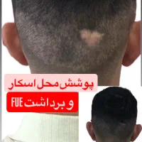 بدون کاشت مو فقط در یک جلسه موهاتو پرپشتت کن