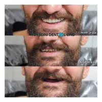 دندانسازی(بلوارهدایت)دندان مصنوعی/دندان سازی|خدمات آرایشگری و زیبایی|مشهد, هدایت|دیوار