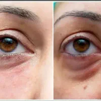 درمان ترک پا|آرایشی، بهداشتی، درمانی|شادگان, |دیوار