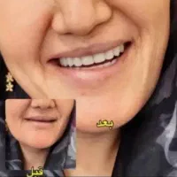 دندان مصنوعی دندان متحرک دندان سازی