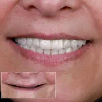 شرایط استثنایی ویژه ایمپلنت دندان