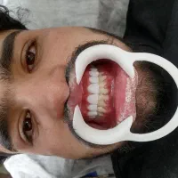 کامپوزیت دندان هر فک 5تومن|خدمات آرایشگری و زیبایی|محمدشهر, محمدشهر|دیوار