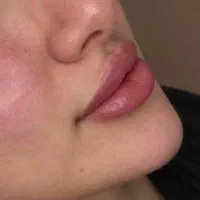 ژل .بوتاکس .فیلربادی.وجراحیهای زیبایی. لیزر