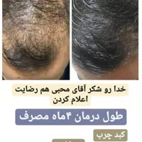 مشاوره ریزش مو و رویش مجدد|خدمات آرایشگری و زیبایی|مشهد, کلاهدوز|دیوار