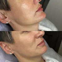 قویترین لیزر الکس شاتی رشت توتال ۹۹۰ با رفع تیرگی|خدمات زیبایی و سلامت|رشت, گلسار|دیوار