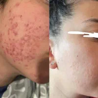 باجوش صورت خدافظی کن ،ضد جوش بیوممتیک هم رسید