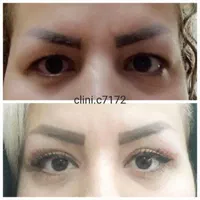 بلفاروپلاستی