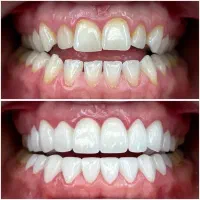 دندانپزشکی/لمینت/روکش|خدمات آرایشگری و زیبایی|تهران, فلسطین (میدان انقلاب)|دیوار