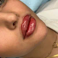 آموزش تزریقات زیبایی