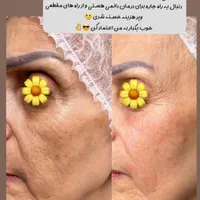 جوانسازی صورت بدون جراحی با تخفیف ویژه|خدمات آرایشگری و زیبایی|تهران, اقدسیه|دیوار